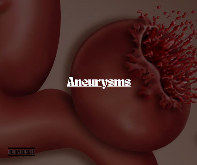 Aneurysms