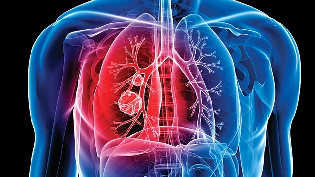 How Do You Prevent Tuberculosis