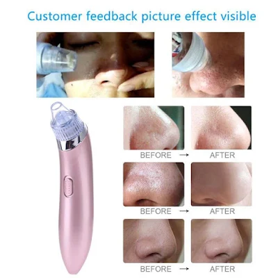 blackhead extractor 