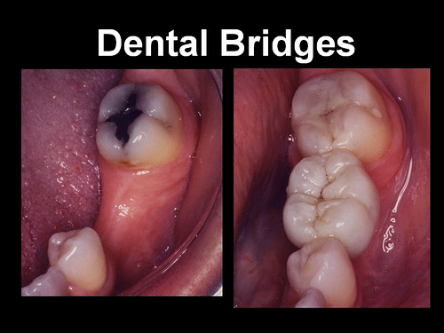 Bridge In Mouth7