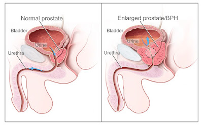 Enlarged Prostate/BPH