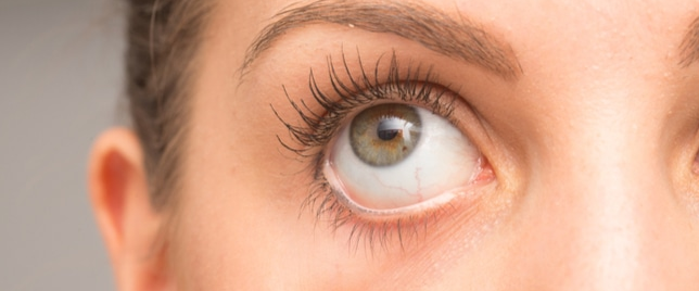 Natural Ways to Treat Dry Eyes, including Moisturizing and Eating Omega 3