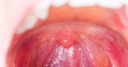 How to Treat Tonsils Permanently and Naturally