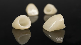 Răng sứ titan sử dụng được bao lâu-1