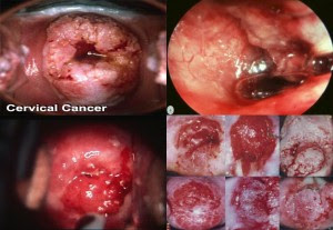 kanser pangkal rahim, fakta, lengkap, ketahui, dari, sudut, pandang, Pap smear, vaksin HPV, info, simptom kanser, ujian, suntikan HPV, wanita, usia 18 tahun, bertukar lelaki