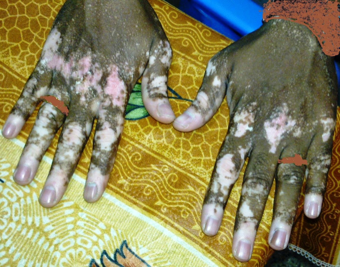    VITILIGO / LEUCODERMA.  An acquired disease of skin, in about 1% of population, wherein "milky white patches" occur on the skin. Often more than one member in a family may suffer. It may follow a serious illness, acute mental stress, some minor or repeated injury or excessive exposure to sunlight. White patches often occur in burn scars too.  Why, How, When & Where? Why? Several ingenious theories have been postulated, but none conclusively proved. Usually starts before 20 years of age, in sun exposed parts like face, back of hands etc. "Milky white" patches appear, gradually increase over several years and then stabilize. Even minor injuries in such a person may cause additional patches. Hairs in affected areas may be black or may turn white too. There is no pain, itching or other symptoms; it is purely a cosmetic problem. It is NOT A CONTAGIOUS disease; but such people are often looked down upon in society. It is often mistaken for and confused with the more dreaded Leprosy.   What to do ? Reassure the patient, all family members AND THE PUBLIC AT LARGE, that it is an absolutely harmless and non contagious disease. there is no assured treatment in allopathic system of medicine long term homoeopathic medicine is helpful to recover from Vitiligo, further more details mail us about your doubts to consult.ur.dr@gmail.com  finally Vitiligo or Leucoderma is a harmless non contagious skin disease. In others, treatment is advised purely for cosmetic reasons. Prolonged medical treatment is effective in quite a few patients.   Homeopathy Treatment for Vitiligo – Leucoderma  Symptomatic Homeopathy works well for Vitiligo – Leucoderma, It helps to prevent further recurrence also. So its good to consult a experienced Homeopathy physician without any hesitation.  Whom to contact for Vitiligo or Leucoderma Treatment  Dr.Senthil Kumar Treats many cases of Vitiligo or Leucoderma, In his medical professional experience with successful results. Many patients get relief after taking treatment from Dr.Senthil Kumar.  Dr.Senthil Kumar visits Chennai at Vivekanantha Homeopathy Clinic, Velachery, Chennai 42. To get appointment please call 9786901830, +91 94430 54168 or mail to consult.ur.dr@gmail.com,   For more details & Consultation Feel free to contact us. Vivekanantha Clinic Consultation Champers at Chennai:- 9786901830  Panruti:- 9443054168  Pondicherry:- 9865212055 (Camp) Mail : consult.ur.dr@gmail.com, homoeokumar@gmail.com   For appointment please Call us or Mail Us  For appointment: SMS your Name -Age – Mobile Number - Problem in Single word - date and day - Place of appointment (Eg: Rajini – 30 - 99xxxxxxx0 – Vitiligo or Leucoderma – 21st Oct, Sunday - Chennai ), You will receive Appointment details through SMS