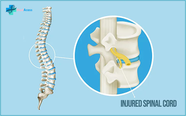 Stem Cell Therapy For Spinal Cord Injury