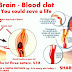 Brain Blood Clot : What to Do In Brain Attack