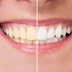 Natural Ways to Whiten Your Teeth