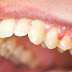 Điều trị viêm chân răng như thế nào?