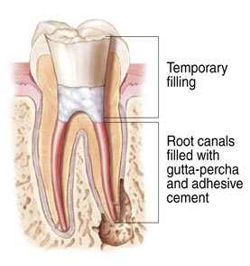 ^^Mama tomei^^: Root Canal Treatment/ Rawatan Akar Gigi