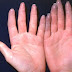 Doença de Raynaud