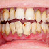Khắc phục tình trạng răng có nhiều cao răng 