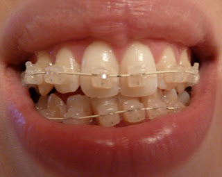 A front on photograph of teeth with ceramic fixed braces at week 10 of treatment