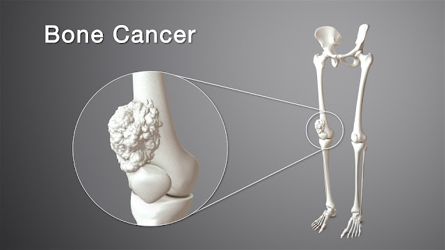 BONE CANCER IN TAMIL