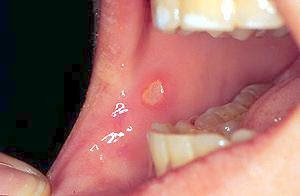 Mouth ulcers are small,