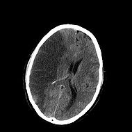 ischemic stroke (left side