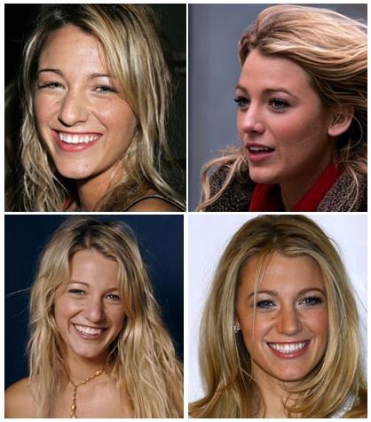 Blake Lively: Before & After her nose job. Before: