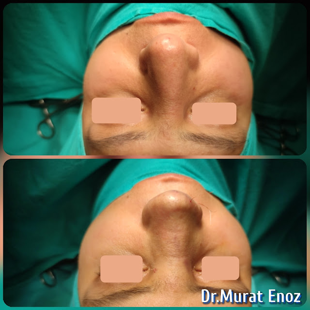 Tertiary Revision Nose Job Rib Cartilage Grafts Removal