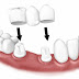 Quy trình làm cầu răng sứ đạt chuẩn