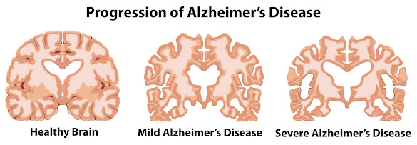 Alzheimer's Disease Dementia