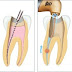  Quá trình lấy tủy bọc răng sứ cho răng sâu 