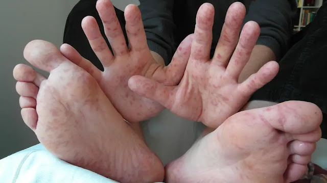 Doença da mão, pé e boca em um homem de 36 anos.