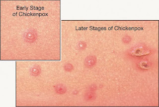 Cara Pengobatan Cacar Air Pada Orang Dewasa