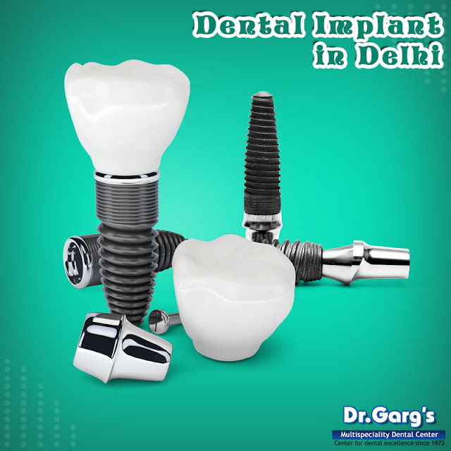 Dental Implant in Delhi