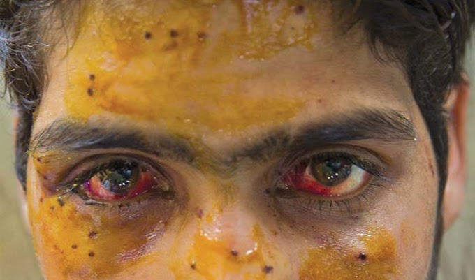 Limited to counting fingers’: 80% of Kashmiri pellet survivors have lost vision partially