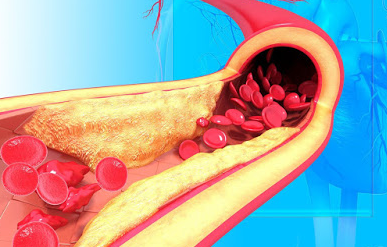 ภาพแสดง ไขมันในเส้นเลือด