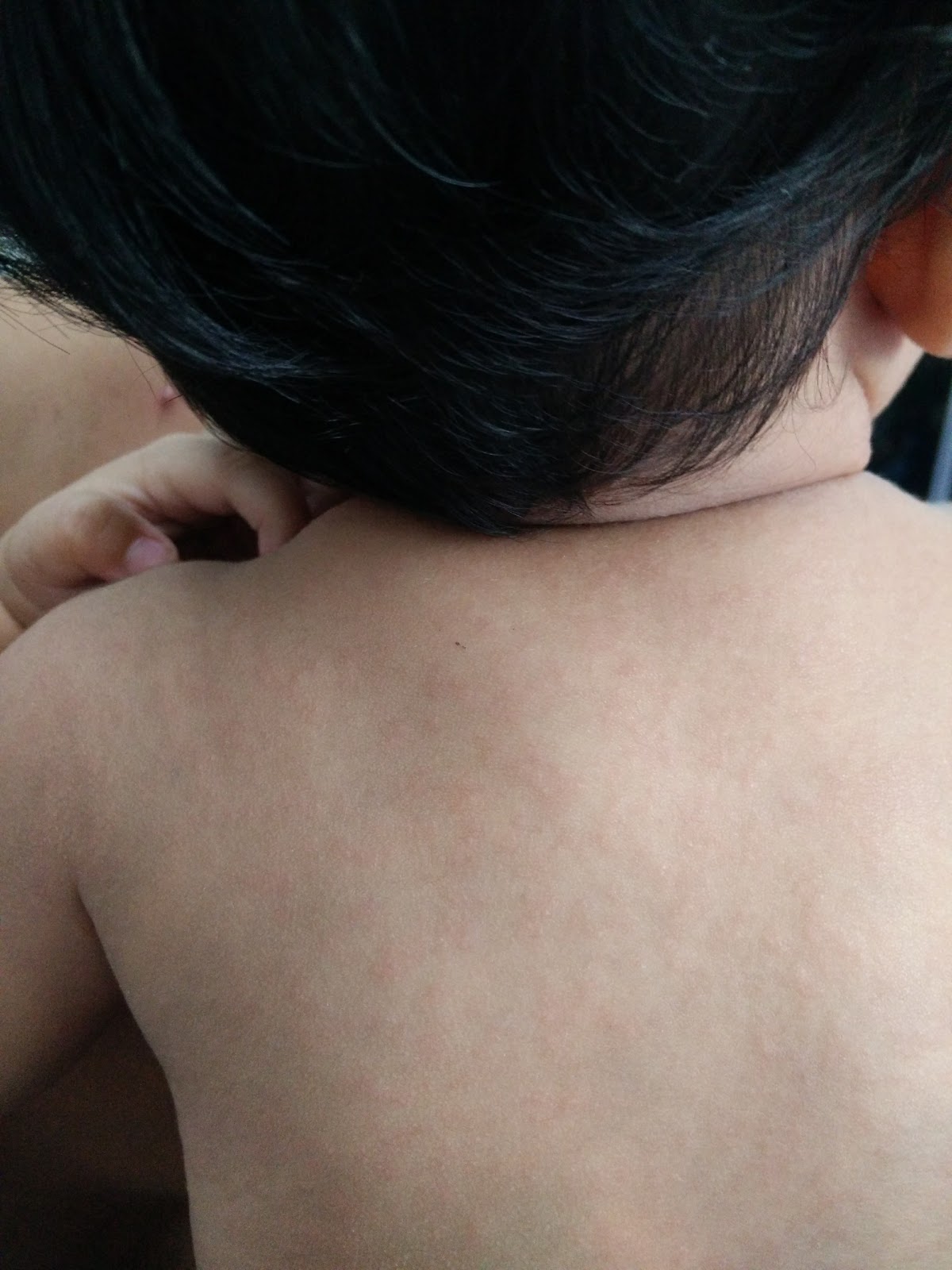 Merawat Anak Kena Demam Campak Rubeola Measles Campak Halus Campak Sekam Ejen Redoxamin Penang