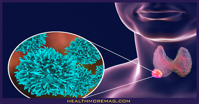 How to treat a thyroid nodule