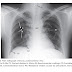 X-Rays of Thorax