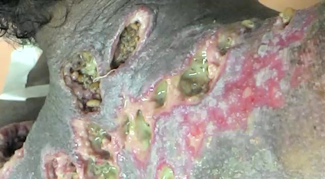 [Video] Miíase infestação de larvas de moscas na pele
