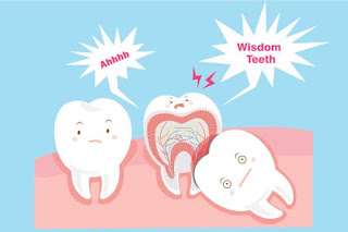  Extraction Of Wisdom Teeth
