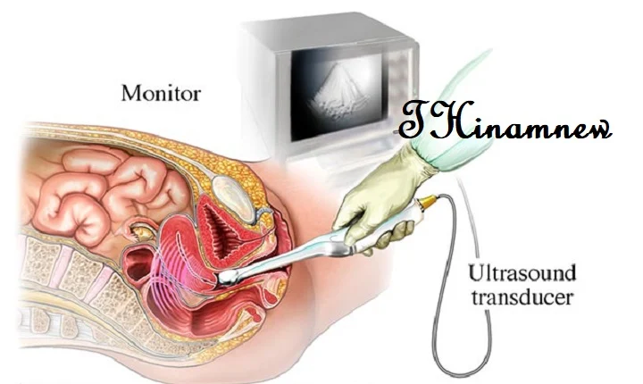 டிரான்ஸ்வஜினல் அல்ட்ராசவுண்ட் ஸ்கேன் என்றால் என்ன?