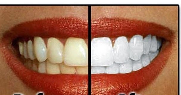 Natural Tooth Whitening Ideas: How to DIY Natural Teeth 