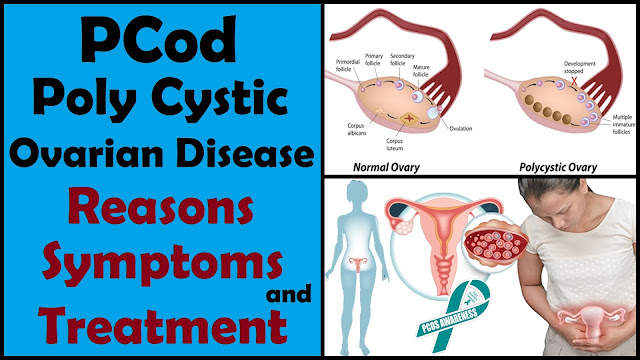 PCod Reasons Symptoms and Treatment