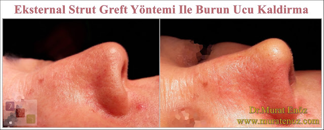 Nose tip drooping - Nose tip reshaping - Lifting the Nasal Tip - Technique of Nasal Tip Lifting - The External Strut Graft Technique- Nasal Tip Lifting - Nose Lift - Nose Lift Surgery - Lift Nose