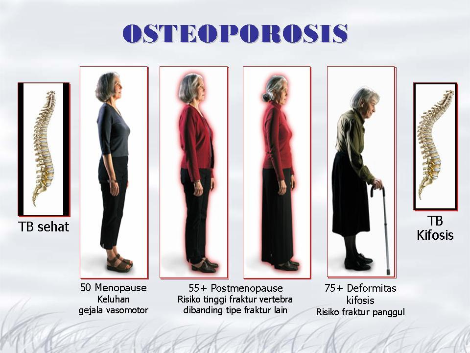 Gambar penyakit tulang osteoporosis