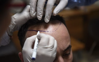 hair transplant in Islamabad