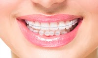 Niềng răng mọc lệch bằng mắc cài kim loại mất bao lâu?