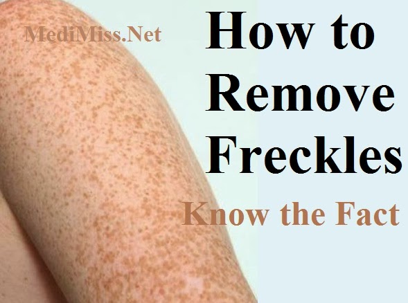 How to Remove Freckles – Know the Facts