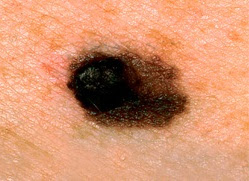 skin cancer spots