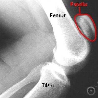 Ronaldo Quadriceps on Como Ocorre A Ruptura Do Tendao Patelar