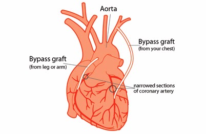 http://www.gohealth.in/treatment/heart-surgery/