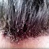 Cuando Veas Lo Que Le Pasó A Este Hombre… Vas A Querer Lavar Tu Pelo 5Veces Al Día – Es HORRIBLE.