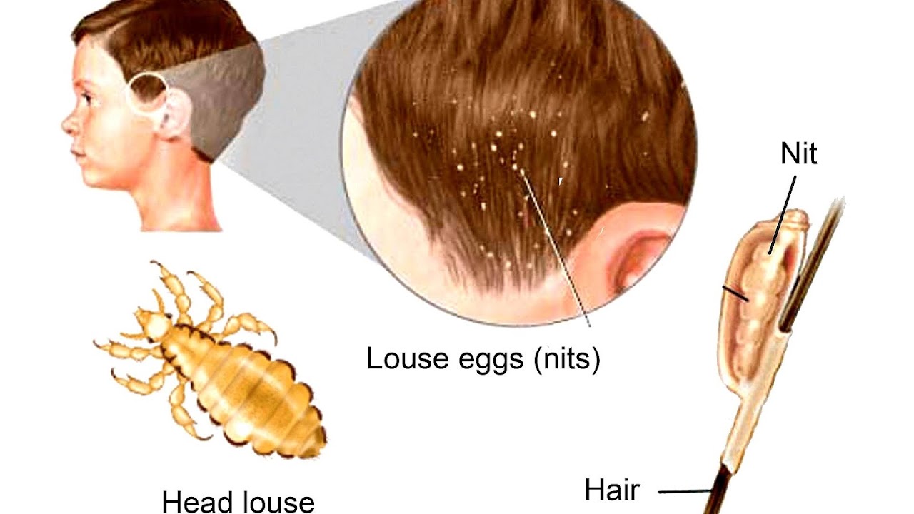 Tea Tree Oil Lice Treatment Recipe