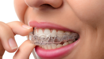 Invisalign Dental Treatment 